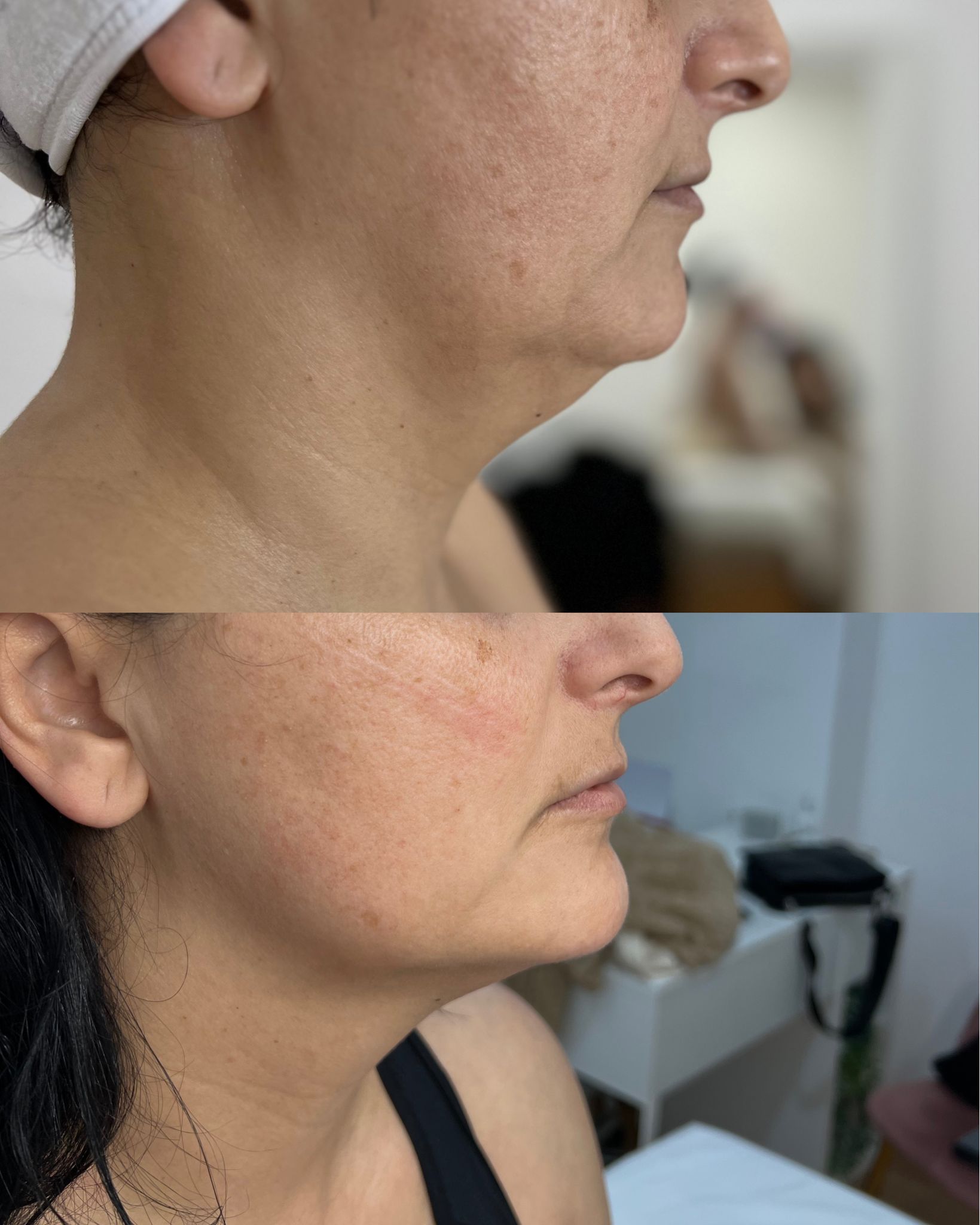 Antes e depois — caso 14