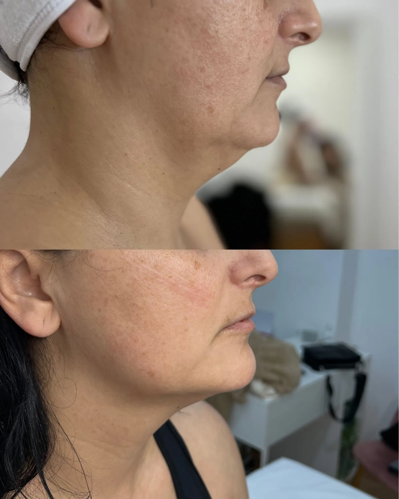Antes e depois — caso 14