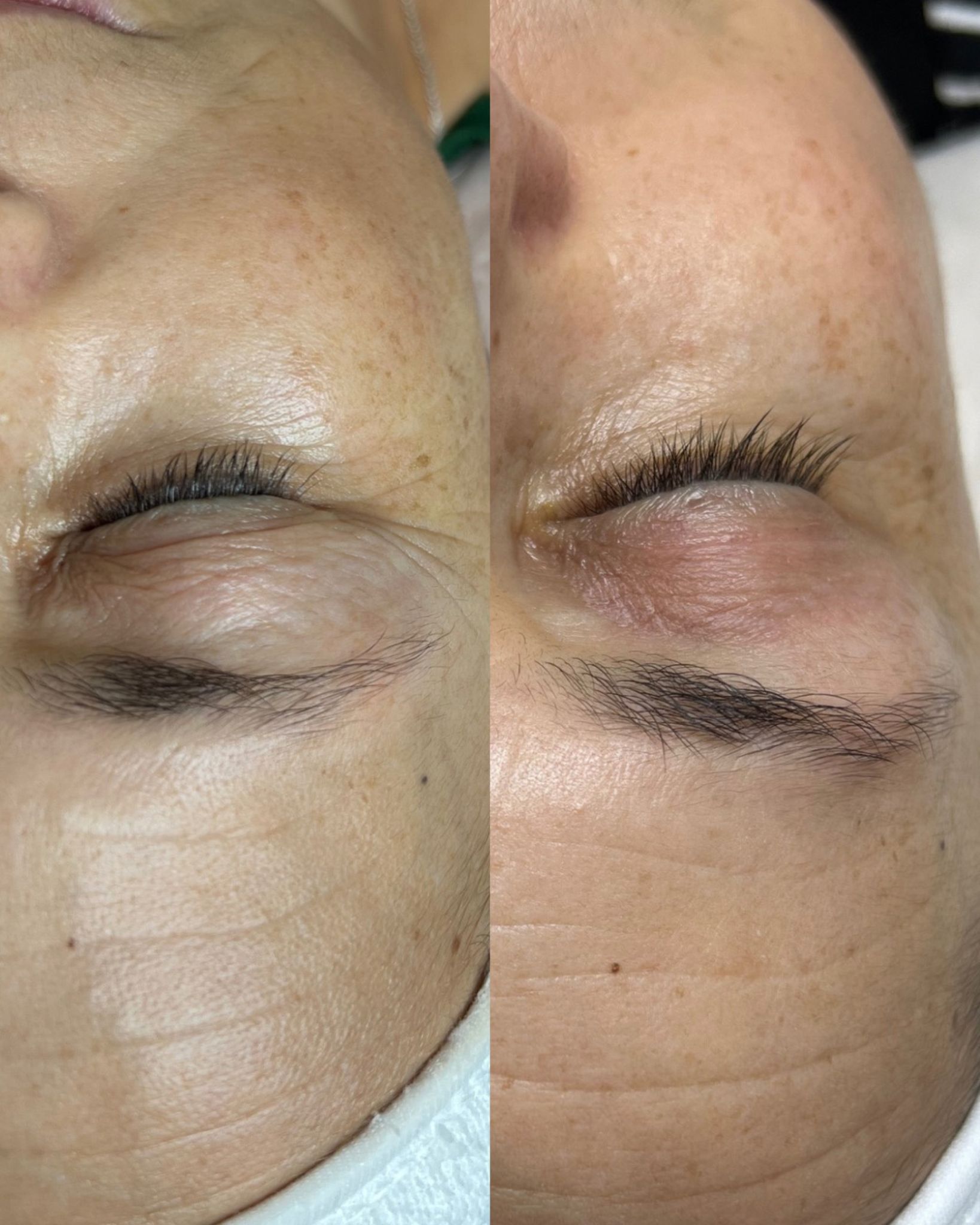 Antes e depois — caso 15