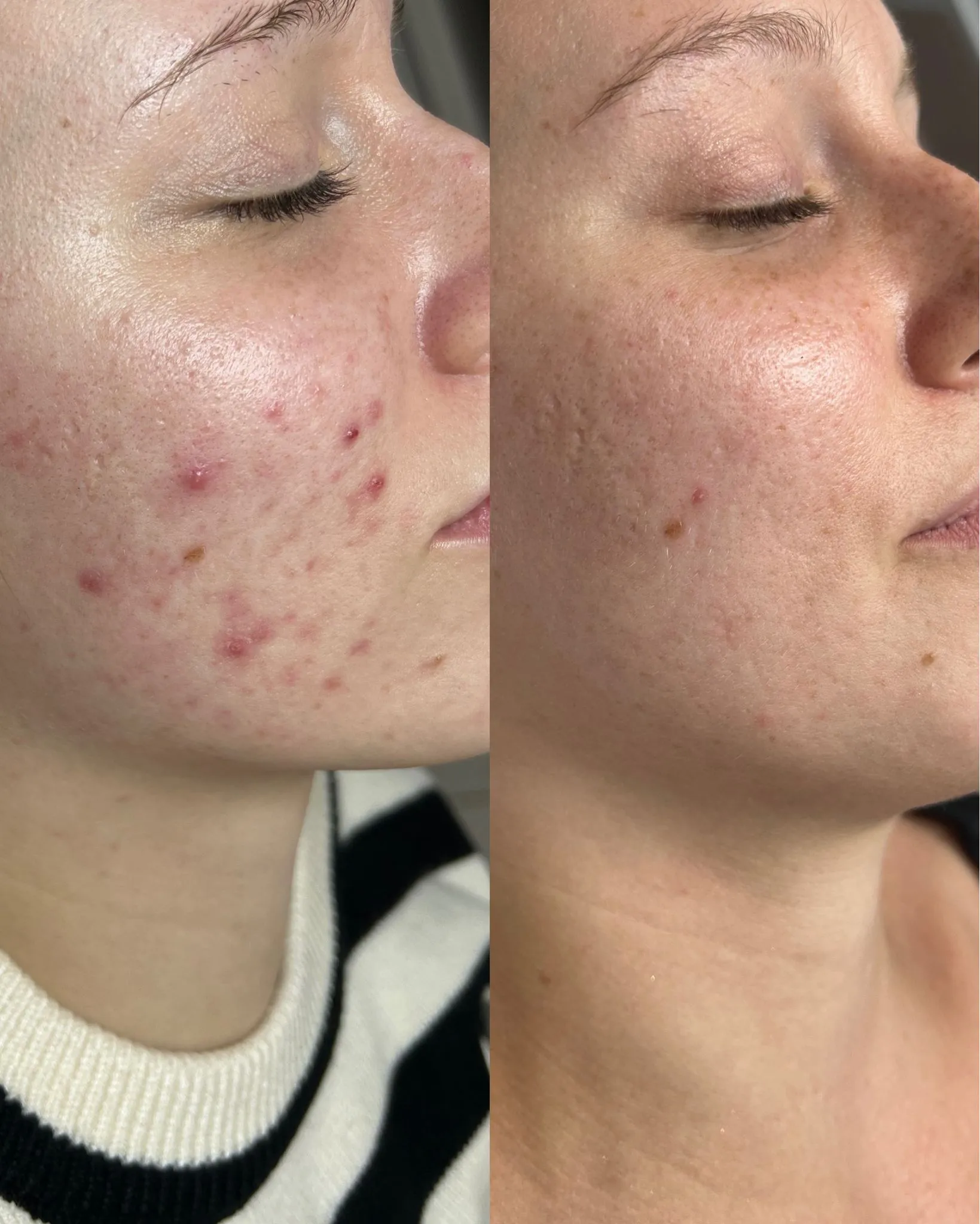 Antes e depois — caso 17