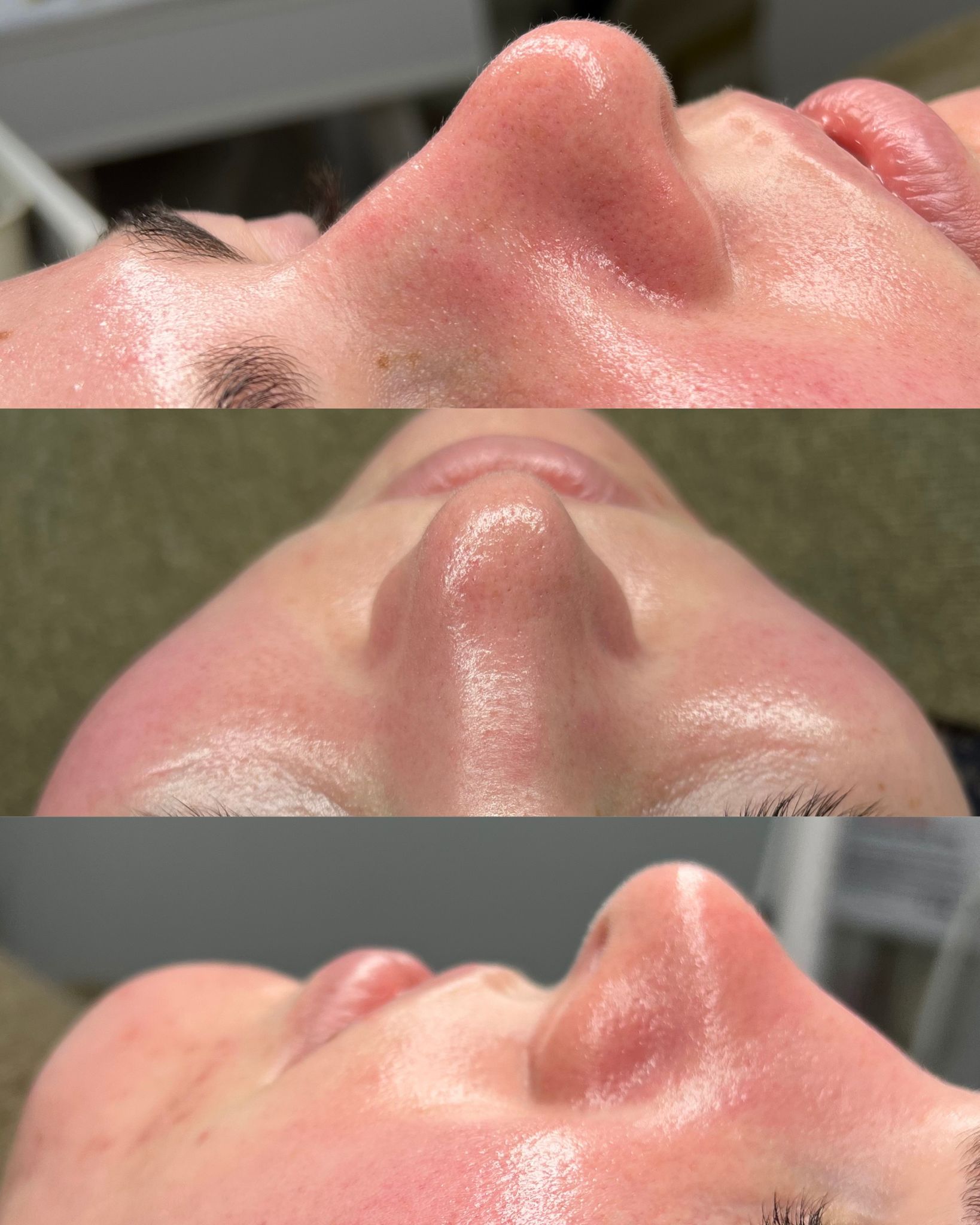 Antes e depois — caso 18