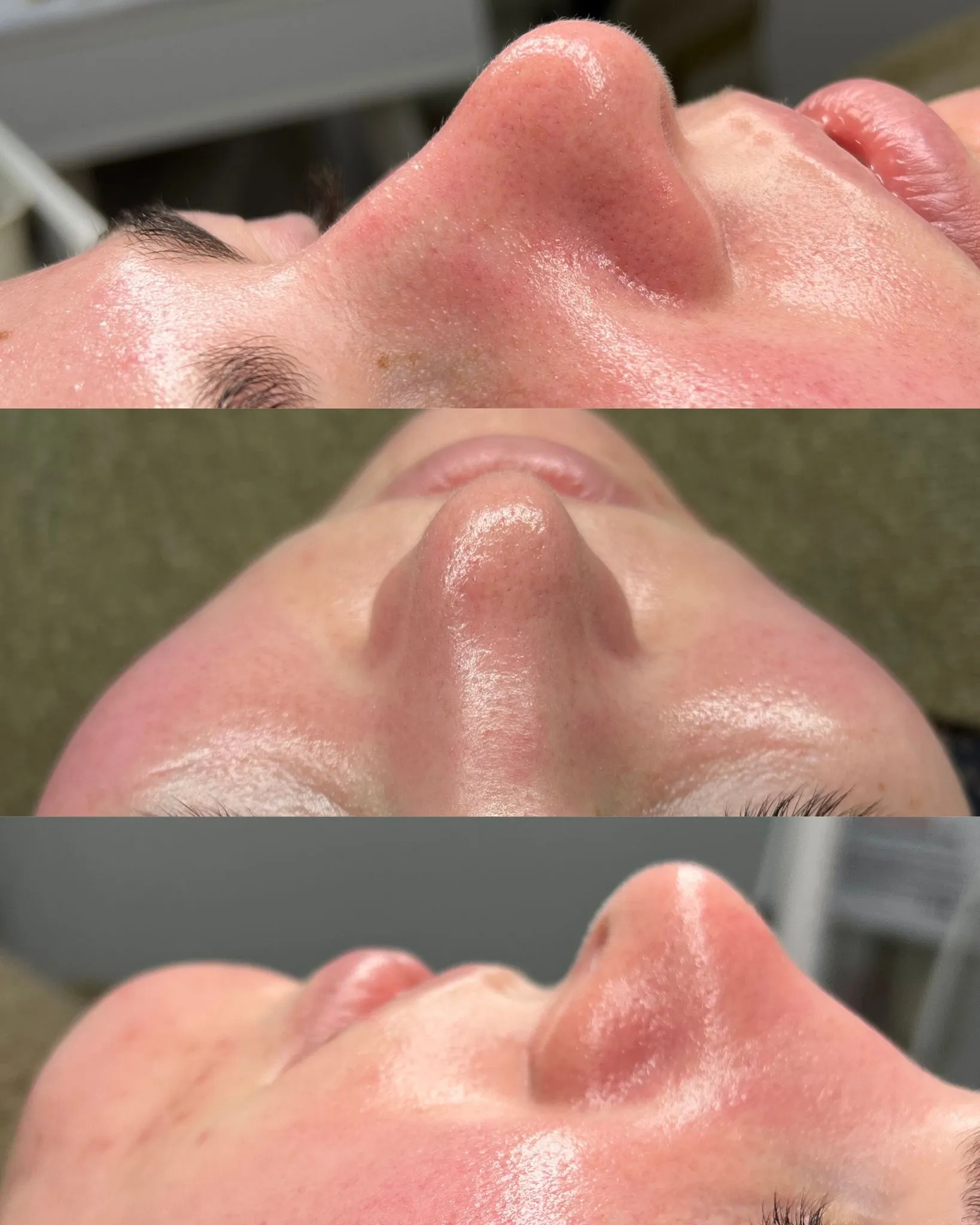 Antes e depois — caso 18
