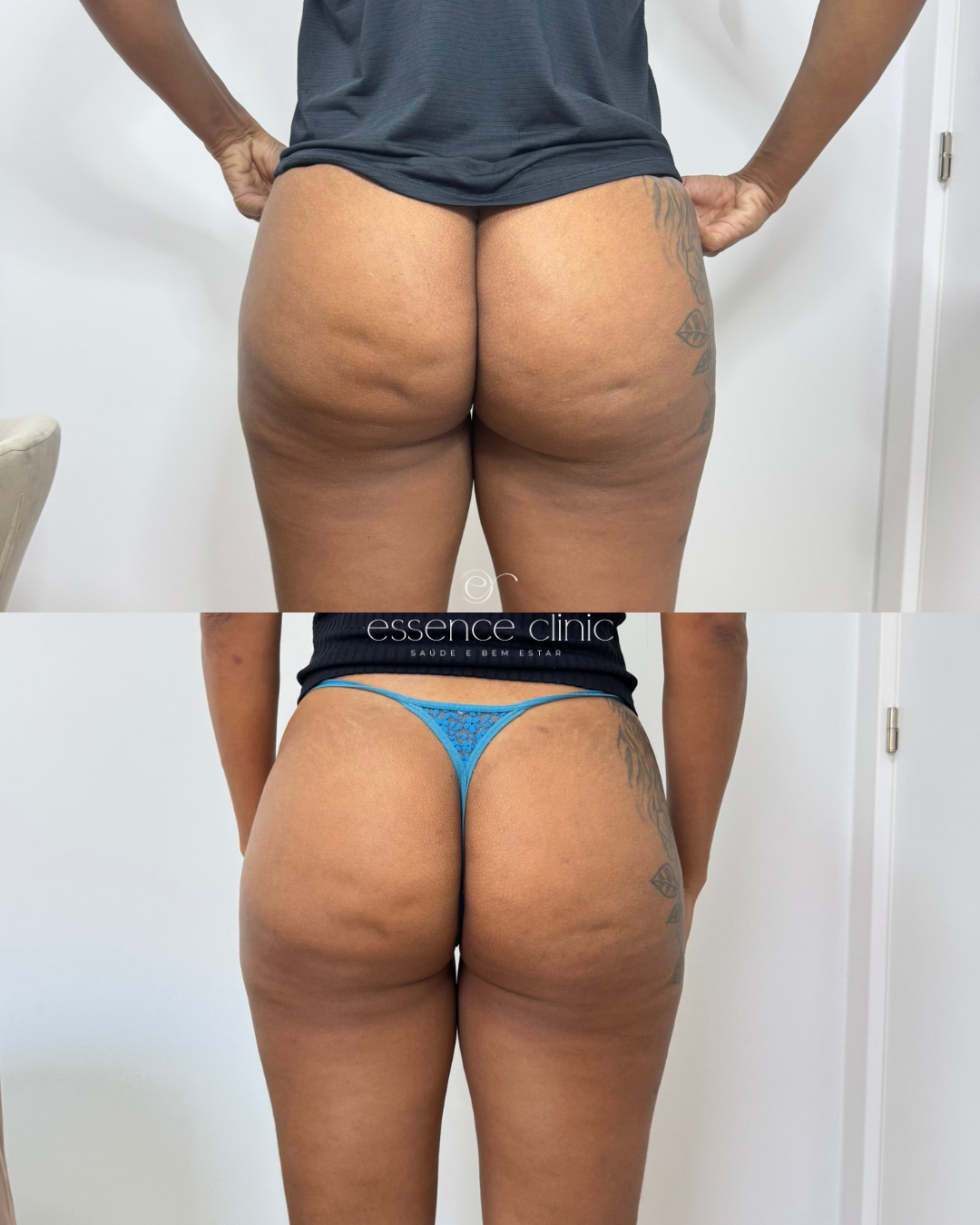 Antes e depois — caso 20