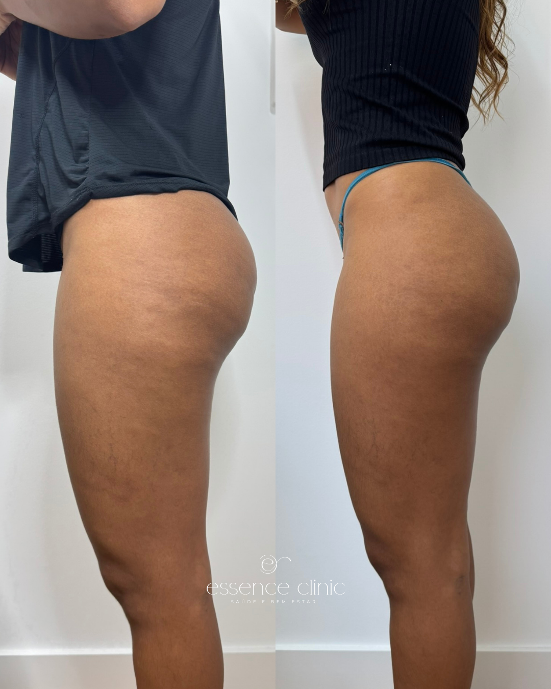Antes e depois — caso 22