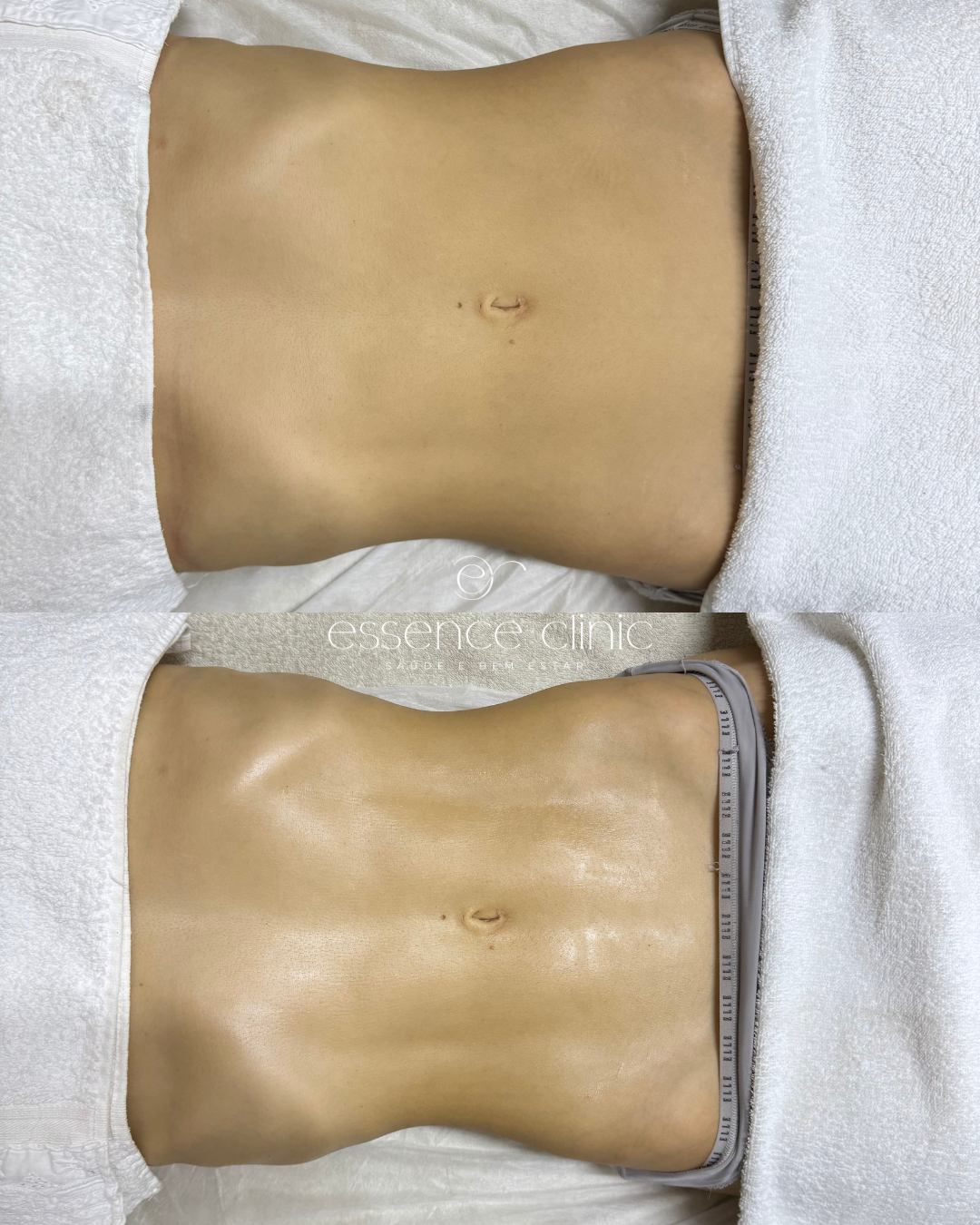 Antes e depois — caso 23