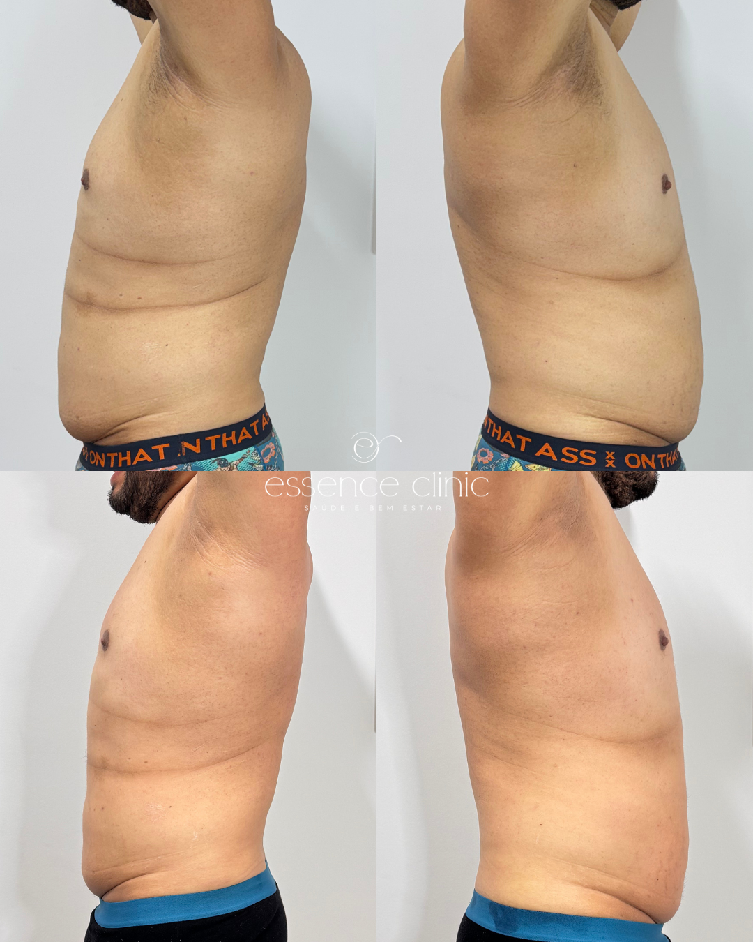 Antes e depois — caso 4