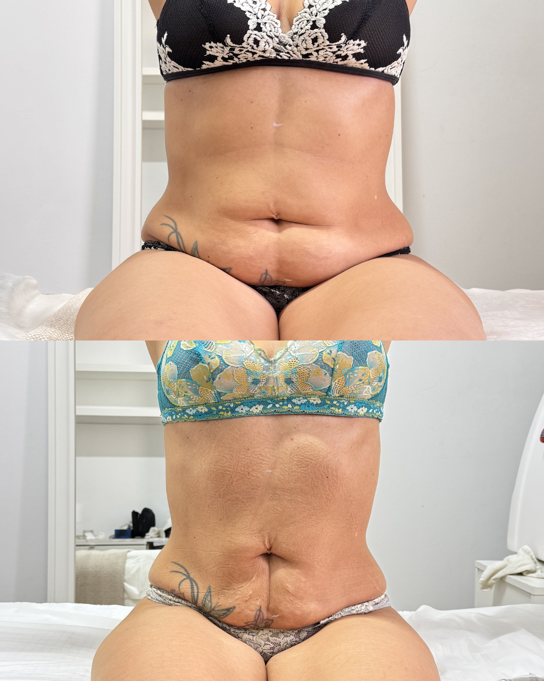 Antes e depois — caso 5