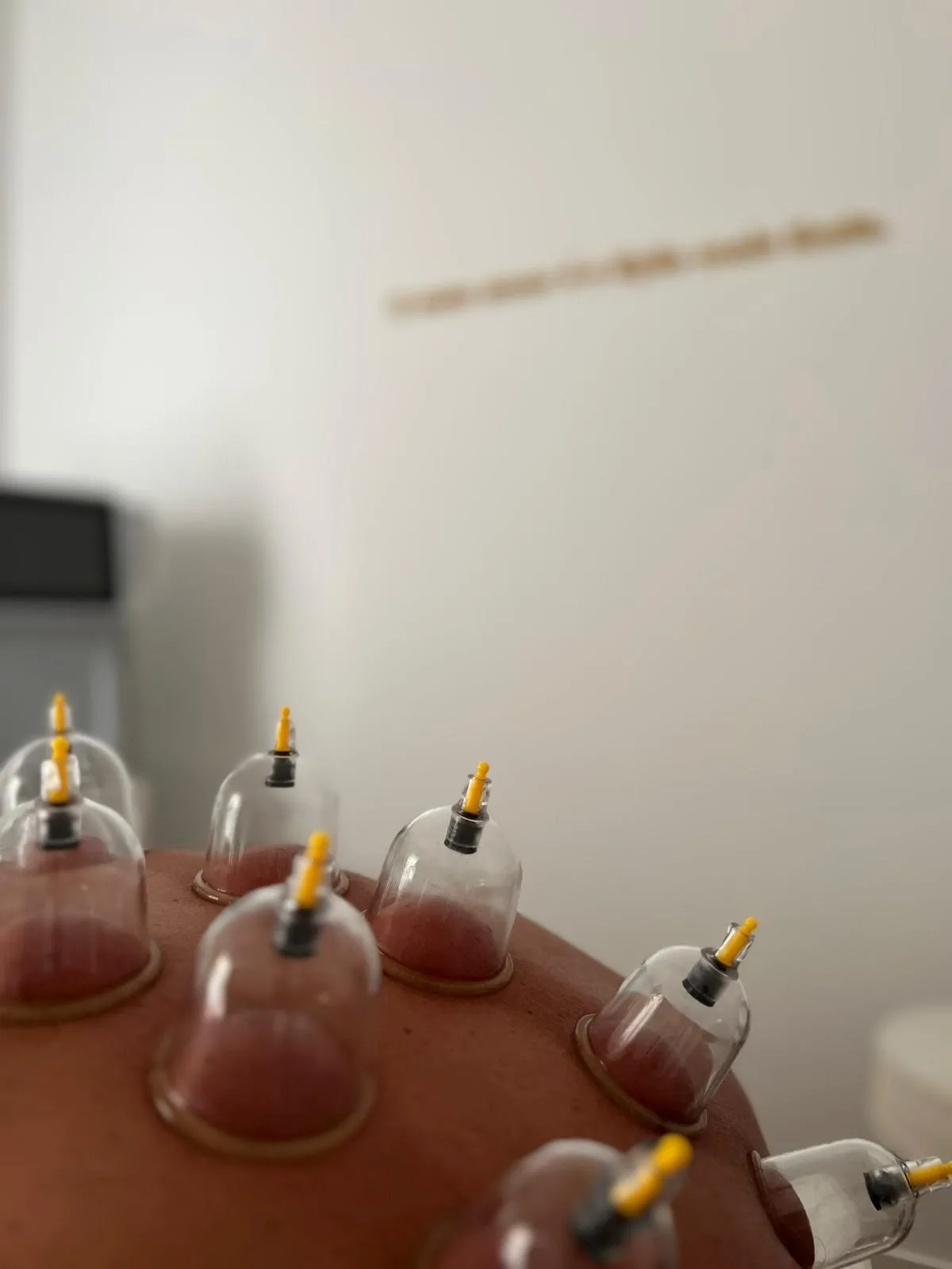 Terapia manual com ventosas para recuperação e bem-estar